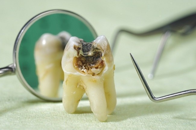 Cara Meredakan Sakit Gigi Dengan Bahan-Bahan Yang Ada Dirumah