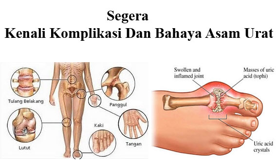 Asam Urat - Apa Sebabnya, Bagaimana Gejalanya, Bagaimana Penanganannya ?